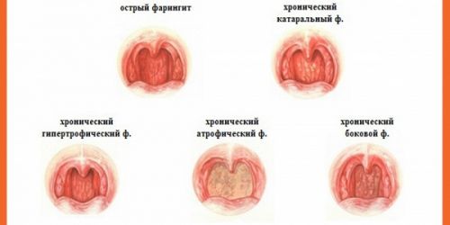 вилікувати хронічний фарингіт назавжди