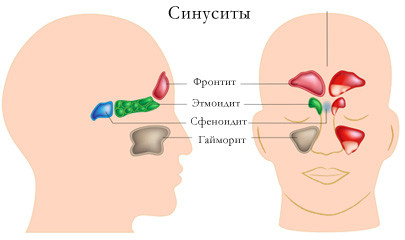 як лікувати запущений синусит