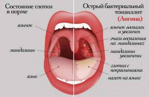 ніж лікувати тонзиліт у дорослих