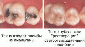 пломбування каналів зуба