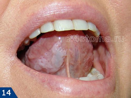 щипає щіпіт мову печіння рот кінчик причини