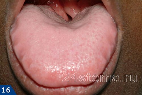 щипає щіпіт мову печіння рот кінчик причини