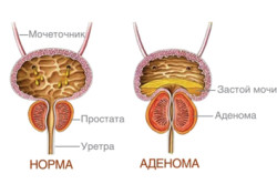 аденома нирки лікування народними засобами симптоми