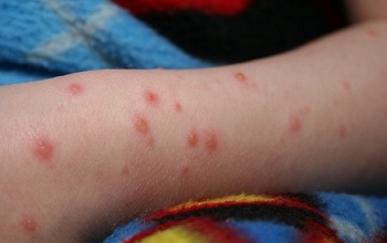 алергічний висип у дітей