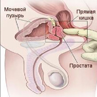 чи можна вилікувати ендометріоз антибіотиками