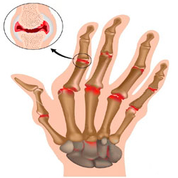 лікувати суглоби пальців рук