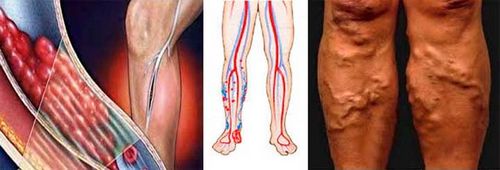 як лікувати варикоз глибоких вен