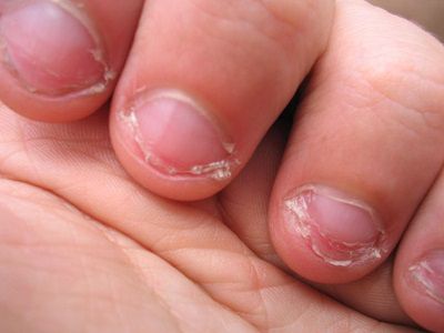 як вилікувати хворі нігті на руках