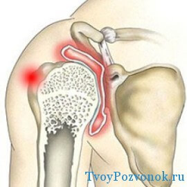 болить плечовий суглоб як лікувати причини лікування правої руки чому болить що робити