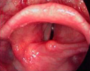 біль першіння в горлі при алергії набряк