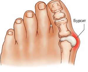 як лікувати бурсит великого пальця стопи