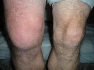 бурсит колінного суглоба симптоми і лікування фото