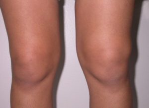 бурсит колінного суглоба симптоми і лікування