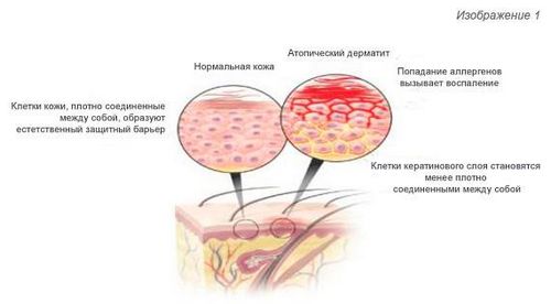 як лікувати себорейний дерматит особи