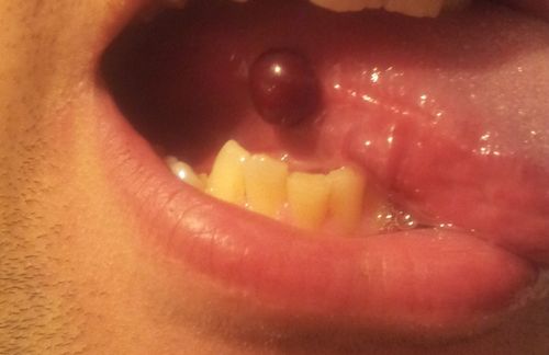 кров'яної міхур кров рот губи ясна лікування що робити що це