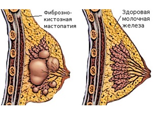 як лікувати лімфовузли вагітним