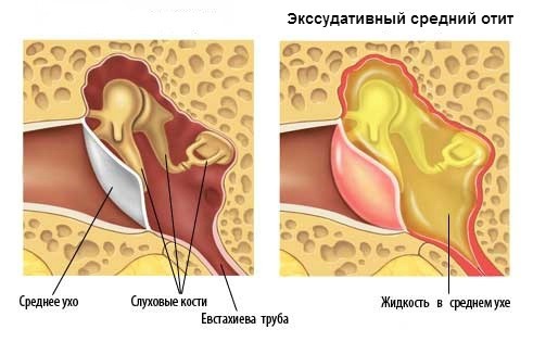 ексудативний отит середнє вухо запалення гній діти причини симптоми лікування барабанна перетинка слух