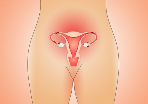 ендометріоз і міома матки