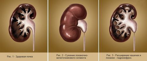 Гідронефроз у новонароджених: діагностика та лікування як лікувати гідронефроз нирки у новонародженого
