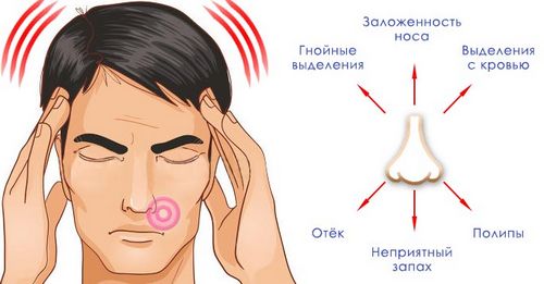 як лікувати грибковий синусит