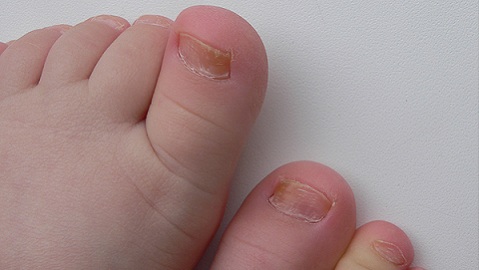 як вилікувати грибок нігтів у дитини