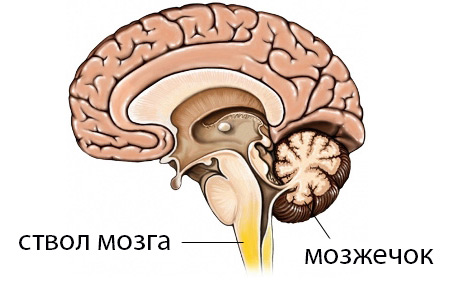 як лікувати інсульт мозочка