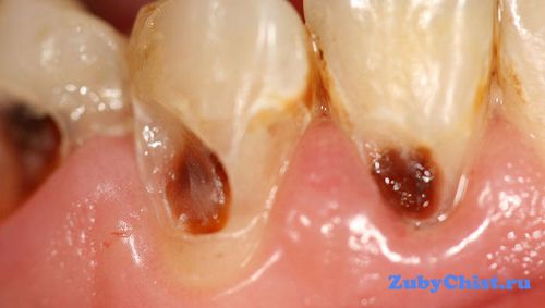 карієс цементу корінь зуб діагностика лікування видалення