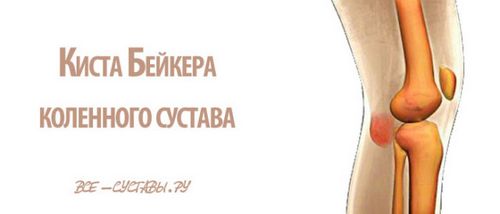 кіста Бейкера колінного суглоба причини лікування видалення