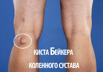 Кіста бейкера колінного суглоба: причини, лікування і видалення як лікувати кісту Бейкера під коліном