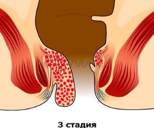 симптоми геморою