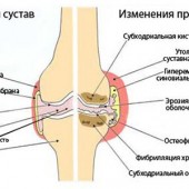 лікування гонартроз колінний артроз суглоб