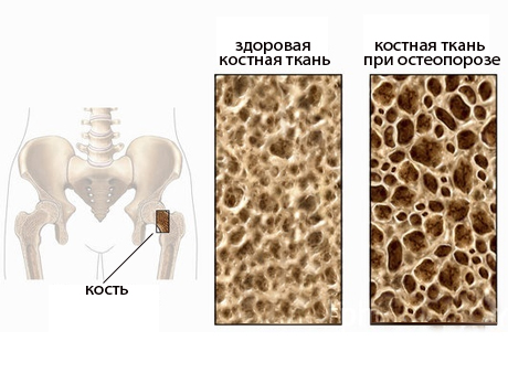 як лікувати остеопороз