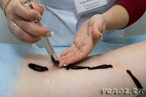 лікування п'явками варикоз гірудотерапія лікує варикозне розширення вен