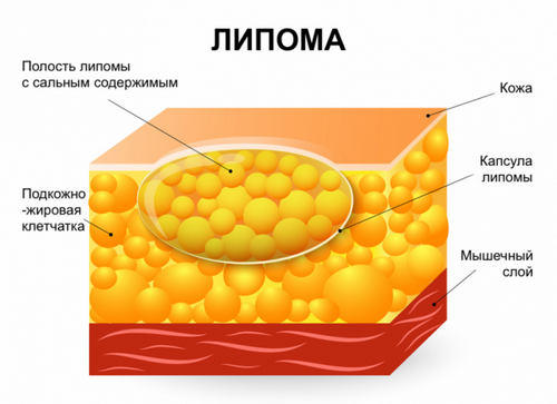 як лікувати жировик на печінці