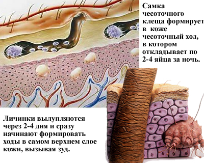 як лікують коросту в лікарні