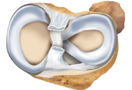меніск коліна симптом лікування травма