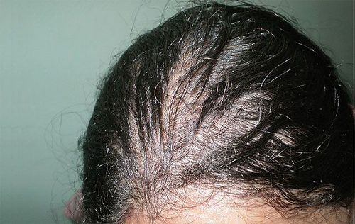 дефіцит йоду і випадання волосся