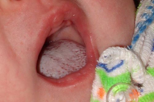 як лікувати кандидоз горла у дітей
