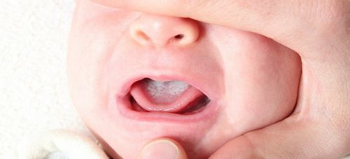 як лікувати молочницю мови