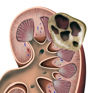 як вилікувати мультикістоз нирки
