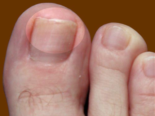лікувати нігті ніг
