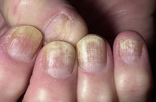 як лікувати грибкове захворювання нігтів