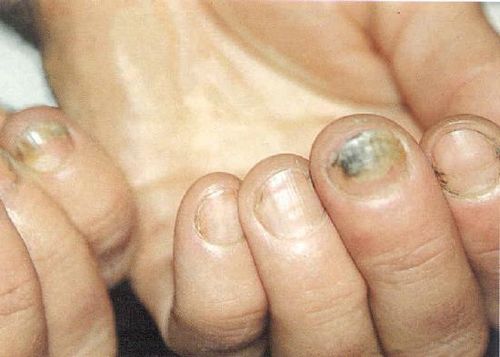 як лікувати грибкове захворювання нігтів