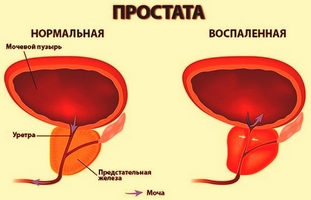 як лікувати рак шлунка содою