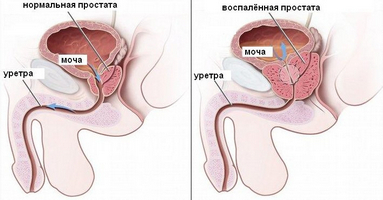 як лікувати рак шлунка содою