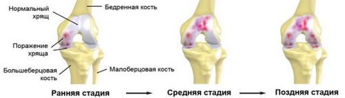 деформуючий остеоартроз колінного суглоба