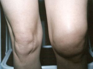 остеоартроз колінного суглоба 2 ступеня лікування
