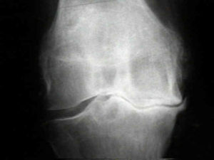 остеоартроз колінного суглоба