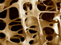 лікувати хворобу остеопороз