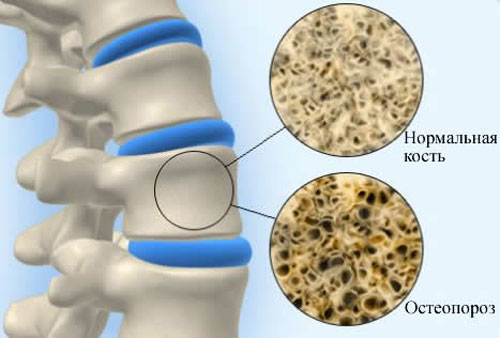 як лікувати остеопороз колін